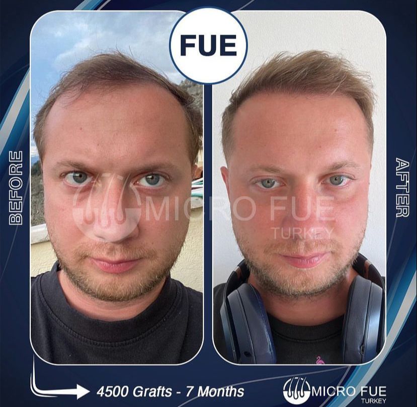 How Is Hair Transplant Pain