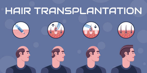 UNSHAVEN HAIR TRANSPLANT MARMARIS