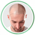 FUE vs DHI Hair Transplant in Marmaris