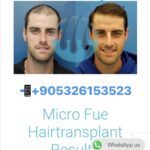Hair Transplant in Marmaris from UK