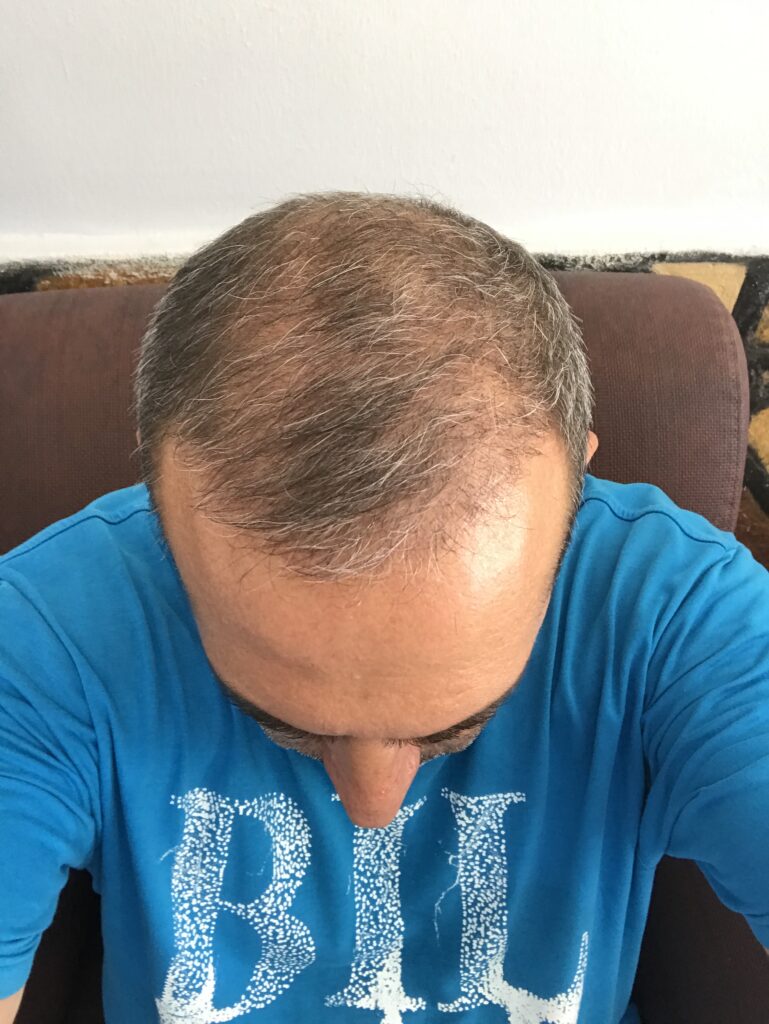 Hair Transplant in Marmaris A One-Day 6-8 Hour Procedure