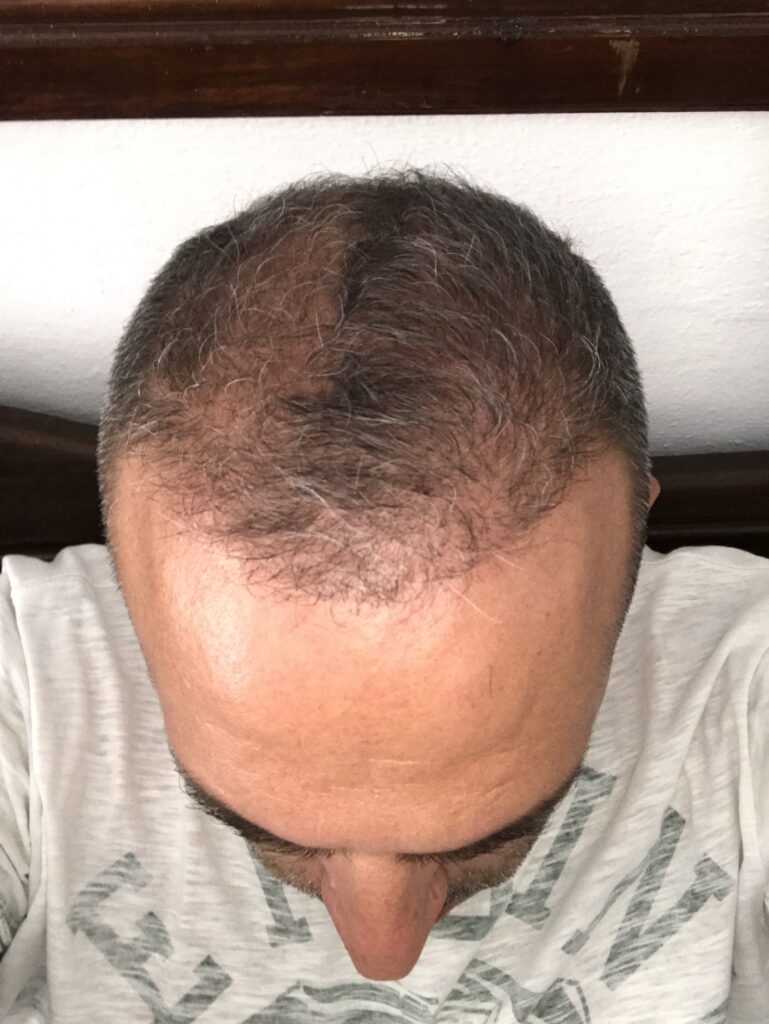 Hair Transplant in Marmaris A One-Day 6-8 Hour Procedure