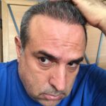 Hair Transplant in Marmaris A One-Day 6-8 Hour Procedure