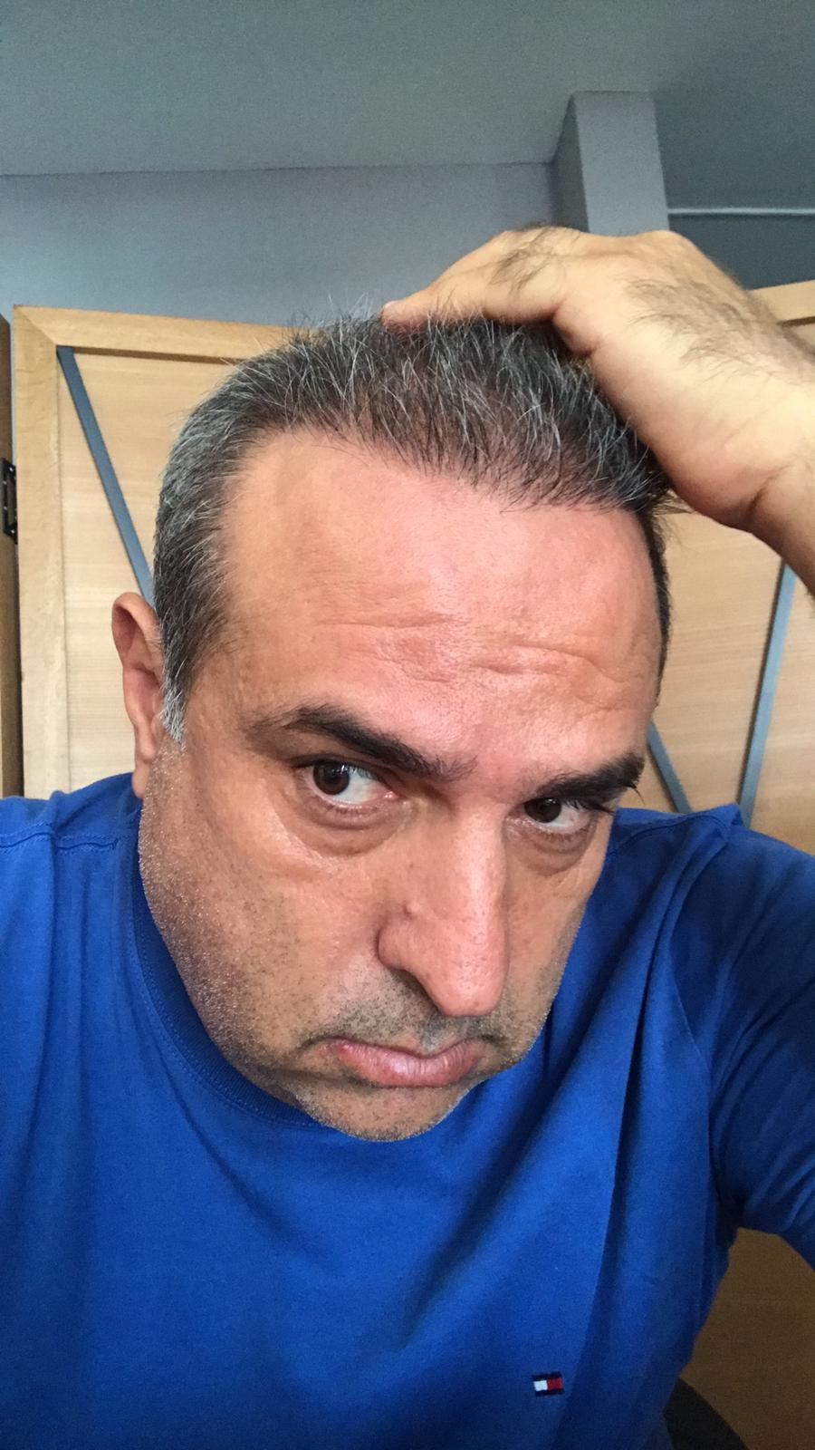 Hair Transplant in Marmaris A One-Day 6-8 Hour Procedure