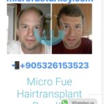 FUE Hair Transplant Marmaris