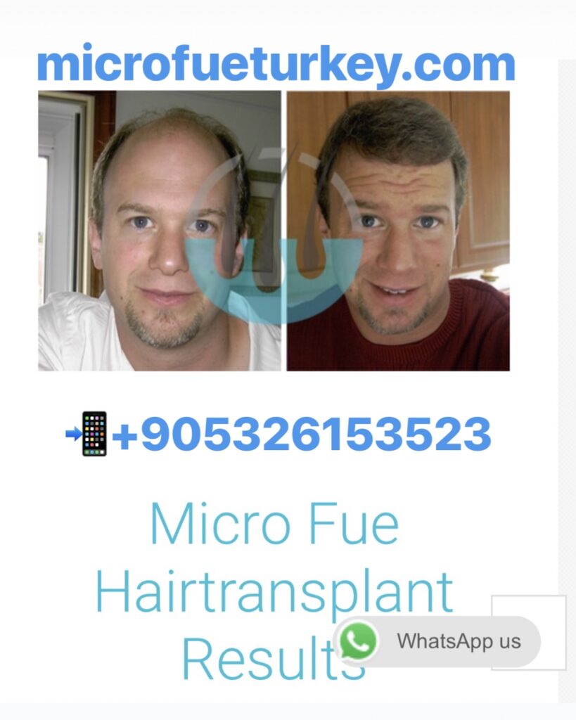 FUE Hair Transplant Marmaris