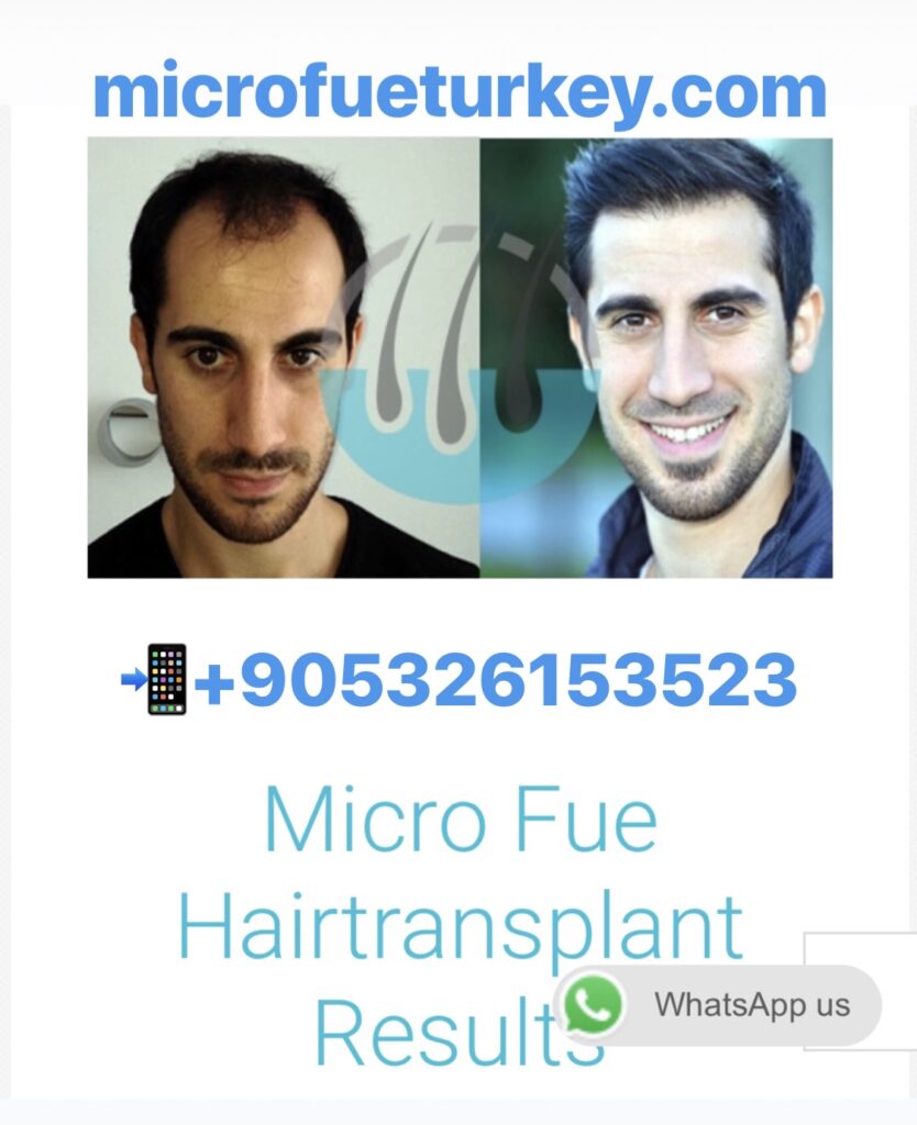 FUE Hair Transplant Marmaris