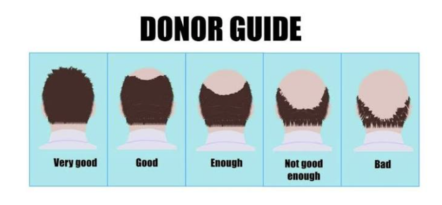 Can You Have a Hair Transplant With a Weak Donor Area?